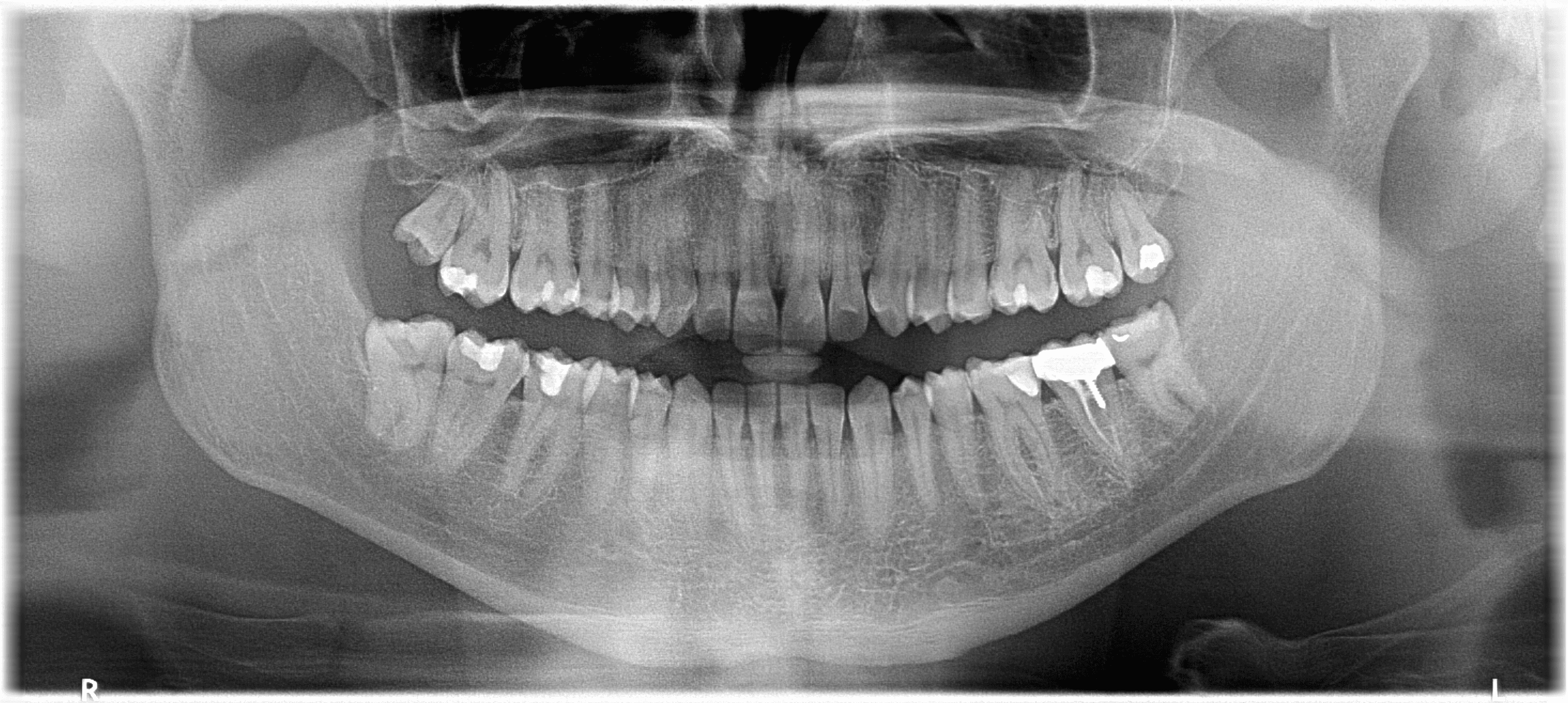 Sample panoramic X-ray