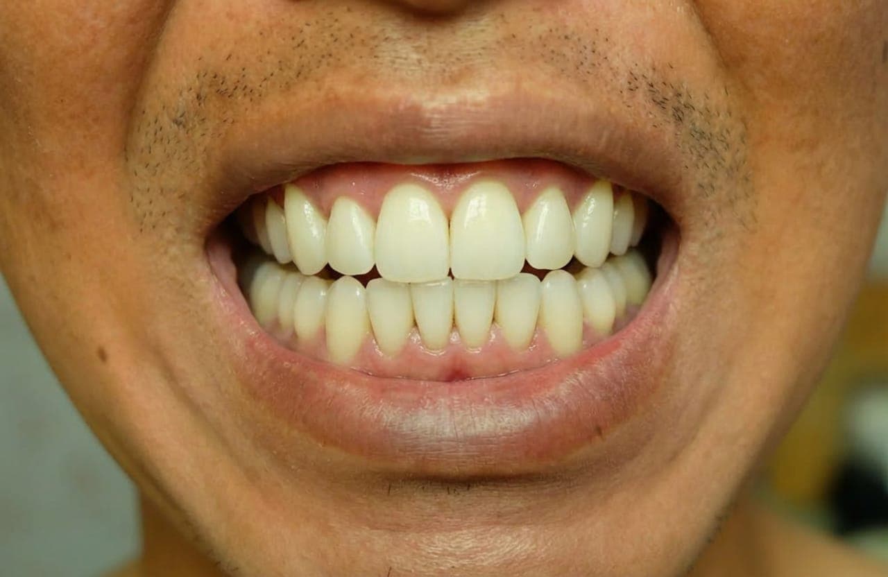 After smile design