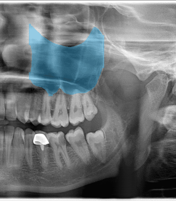 Dental radiograph showing maxillary sinus detection