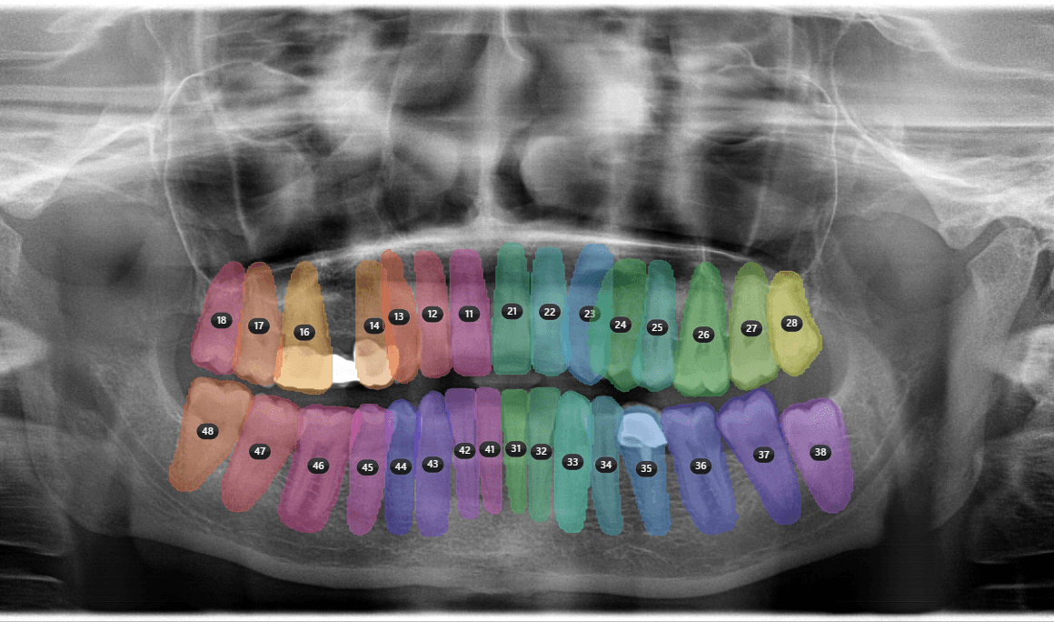 Dental radiograph showing AI teeth segmentation and FDI mapping