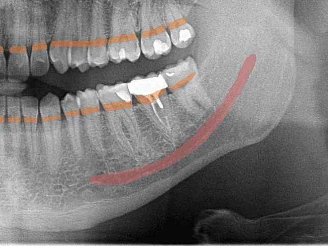 Dental radiograph showing AI anatomy detection landmarks